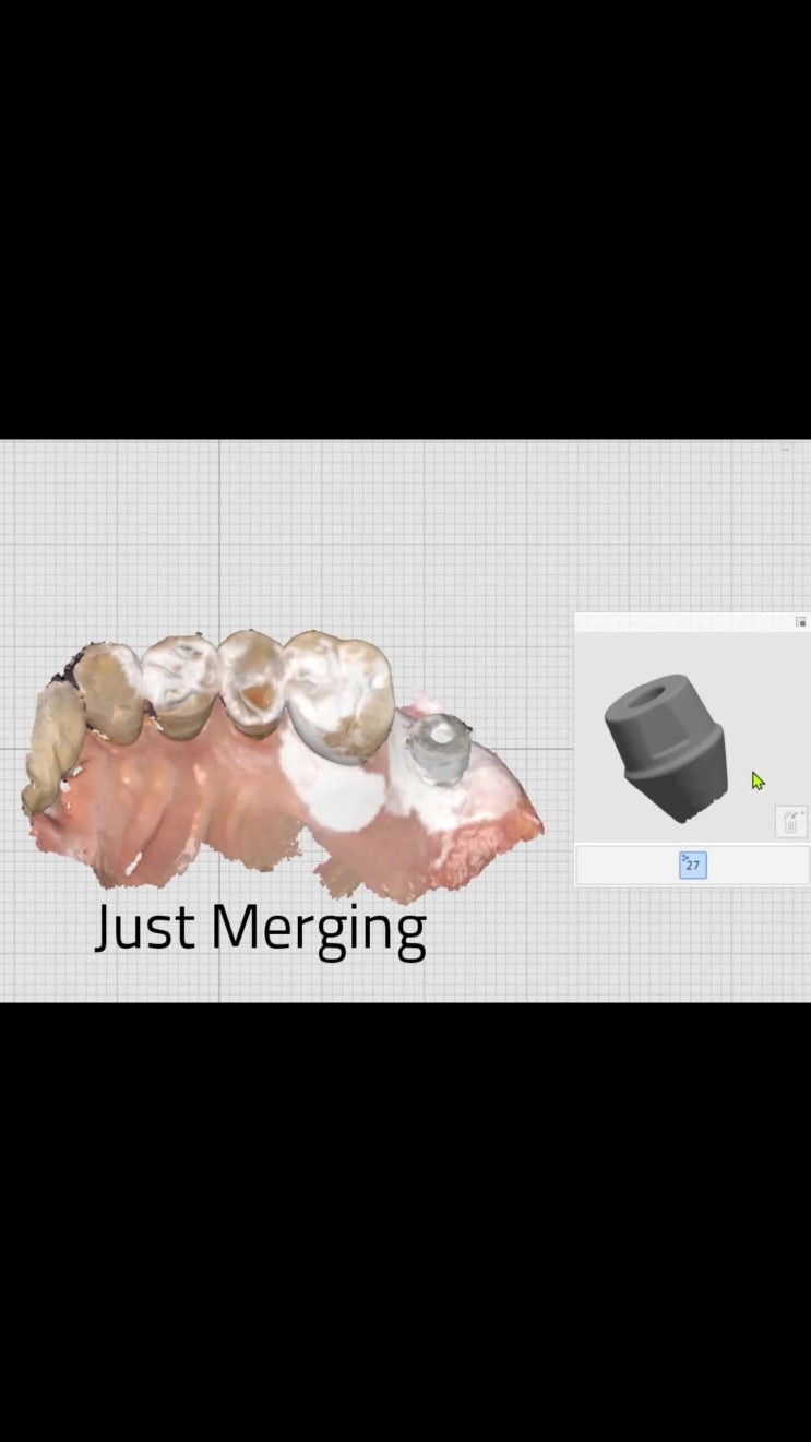 정확한 임플란트 경계면 확인. Abutment Merging 서울예우치과 송우석 박사