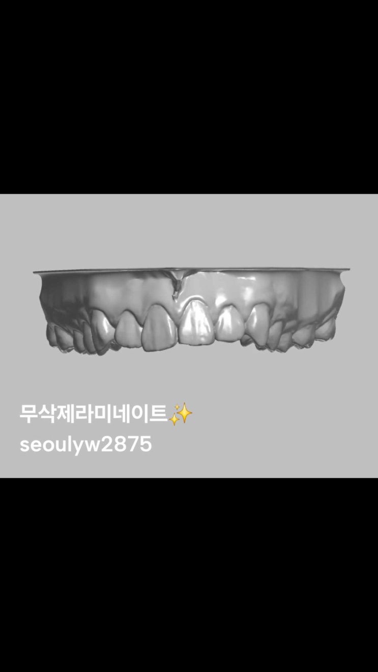 무삭제 최소삭제 라미네이트 서울예우치과