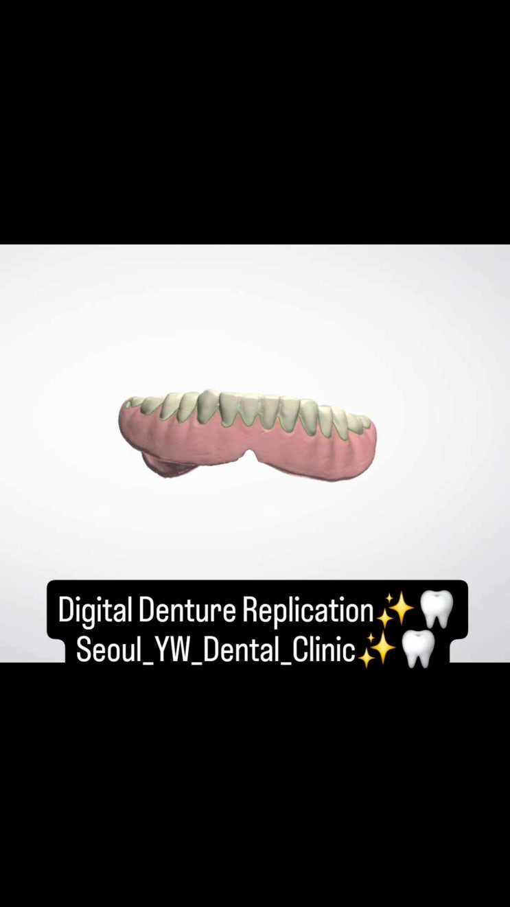 임플란트 치료시 사용하시던 틀니를 꼭 가져오셔야되는 이유 | 디지털 의치 복제 서울예우치과