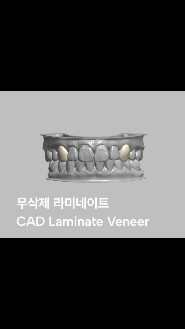무삭제 라미네이트 서울예우치과 송우석 원장